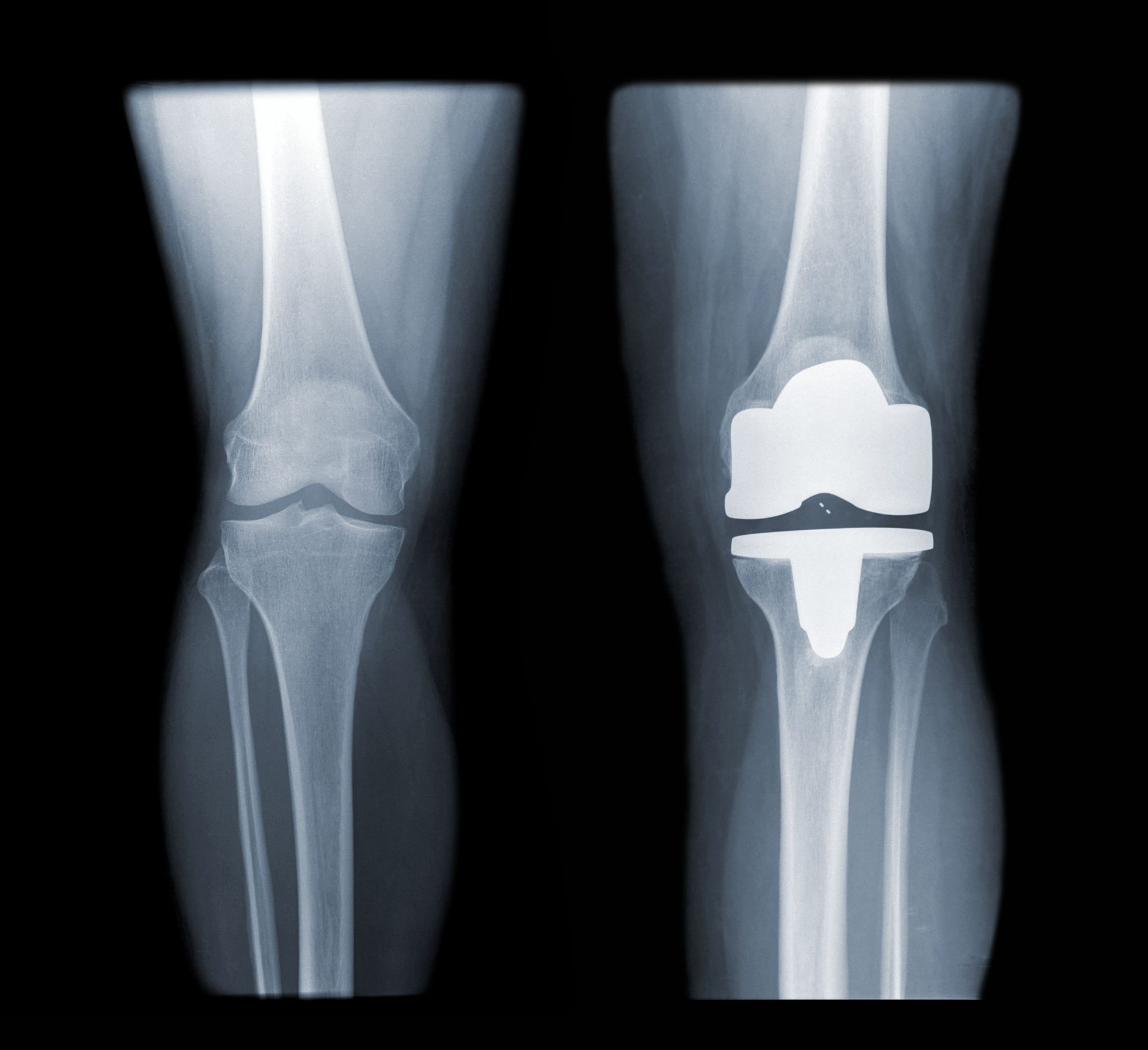 Ortho Xray Knee replacement 1 scaled