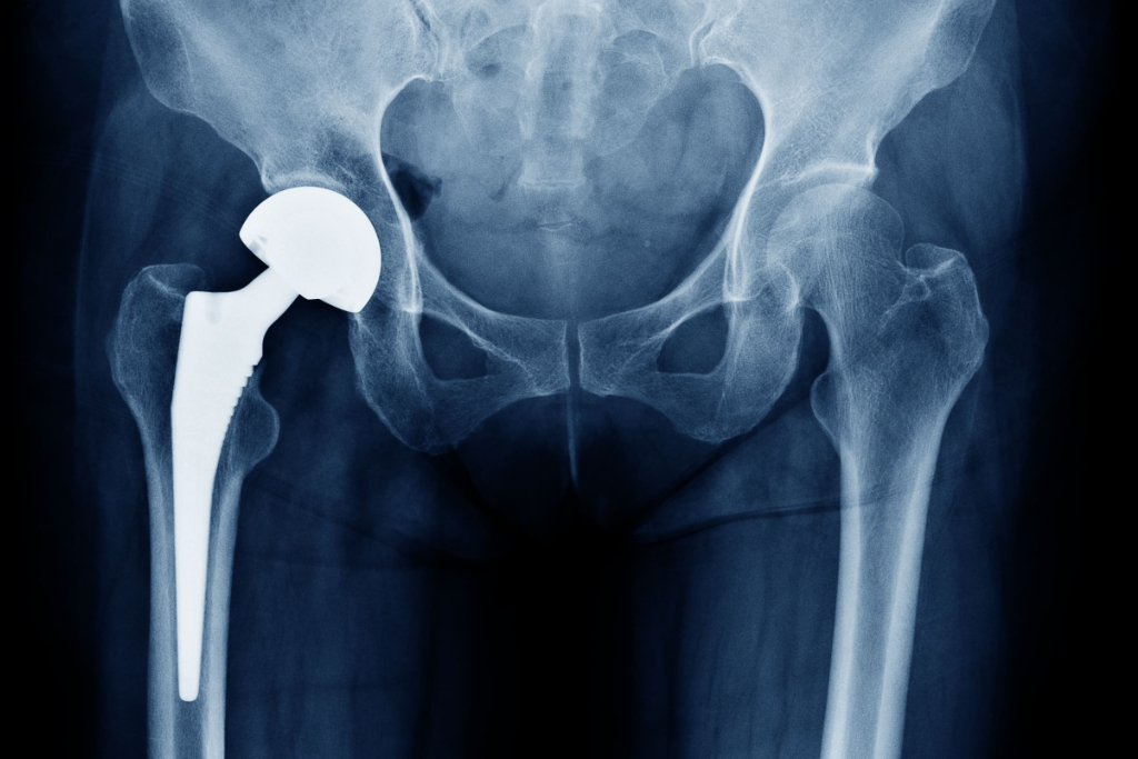 Ortho Total Hip Replacement X Ray Mso Physiotherapy