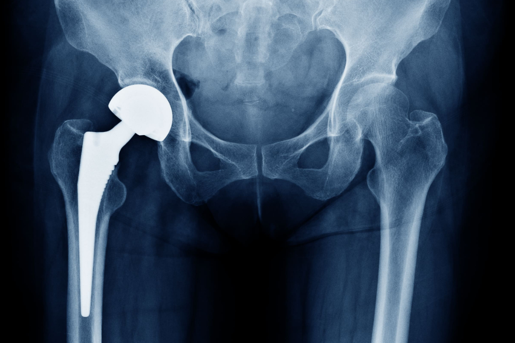 ortho-total-hip-replacement-x-ray-mso-physiotherapy